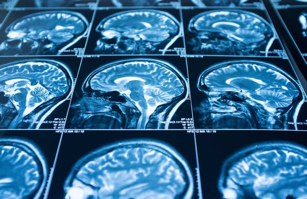 A set of brain MRI scans showing side profile cross-sections, displaying detailed structures of the brain in shades of blue and white.