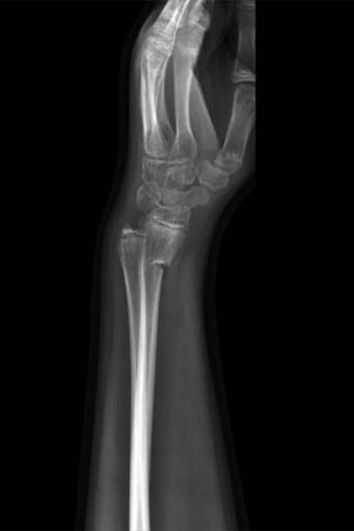 X-ray  of a forearm and wrist showing a clear fracture in the distal radius bone near the wrist joint, with displacement of the broken bone ends.